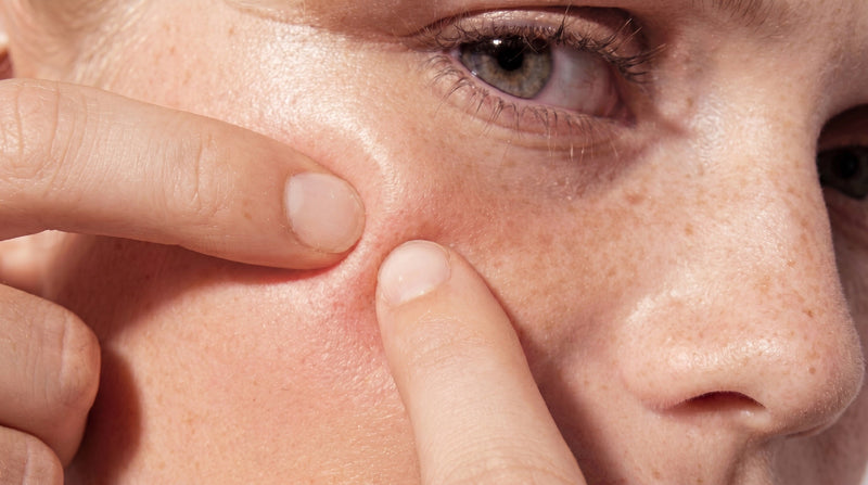 Hard Water and Your Skin: The Link to Dryness and Breakouts