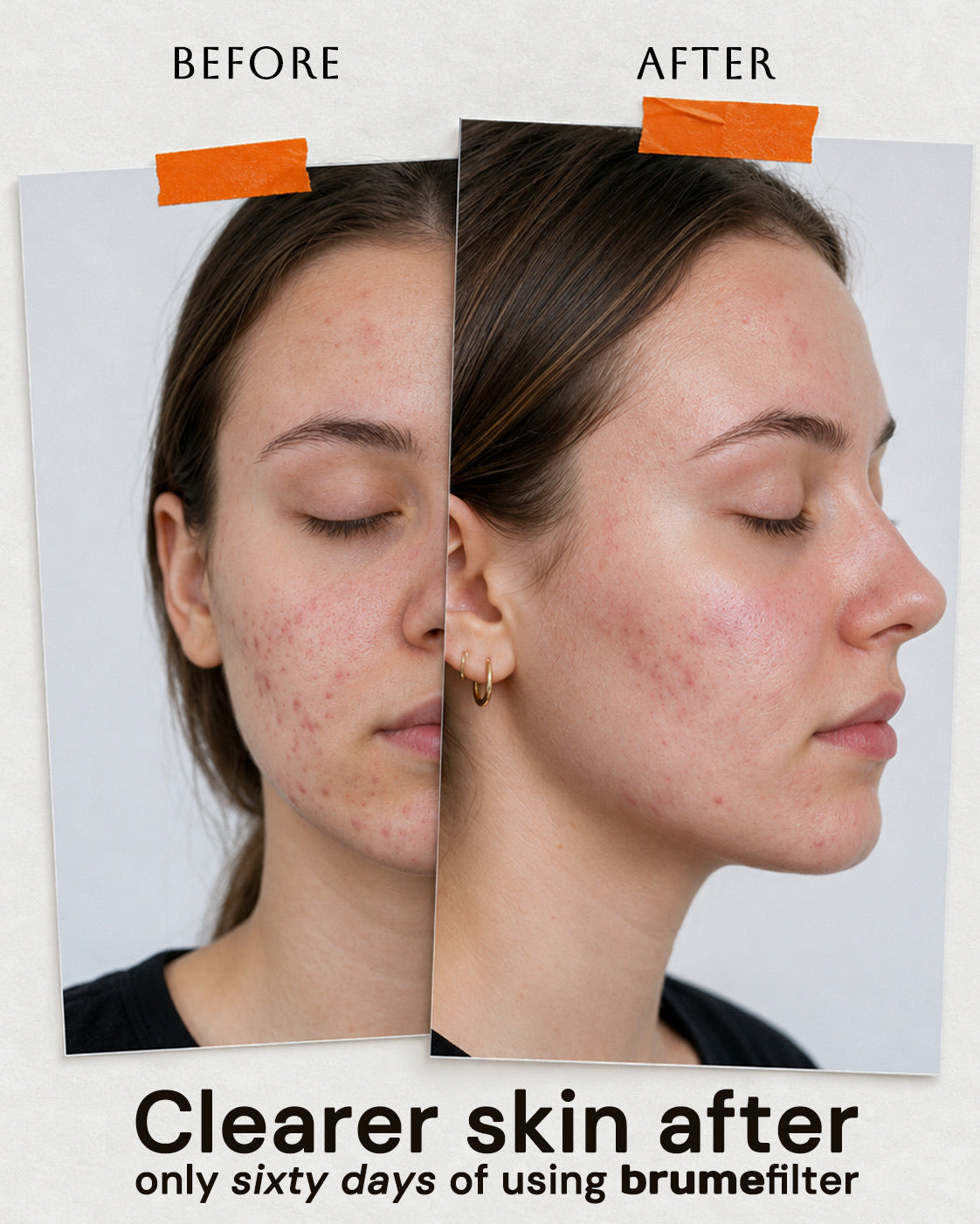 Skin before and after switching to brume filtered water